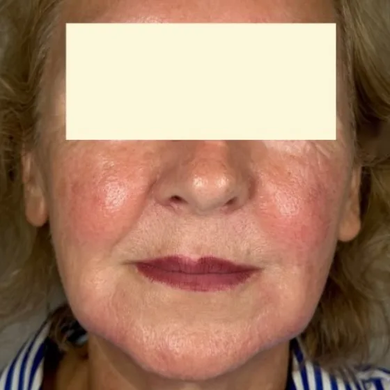 After: full face dermal filler