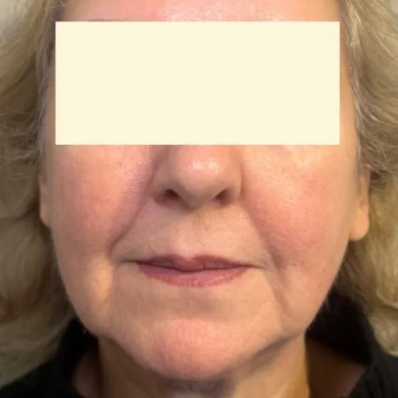 Before: full face dermal filler