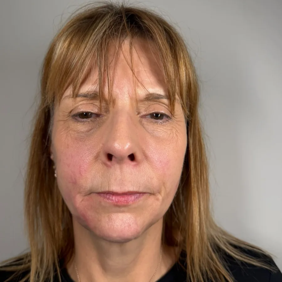 After: dermal filler for profile balancing