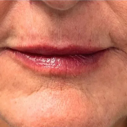 After: lip filler and lower face