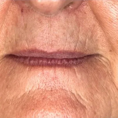 Before: lip filler and lower face
