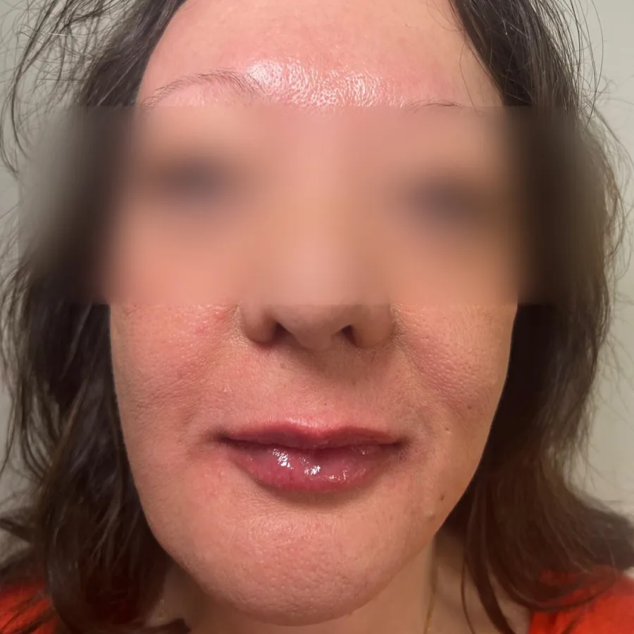 After: lip filler