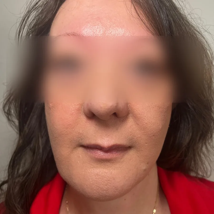 Before: lip filler