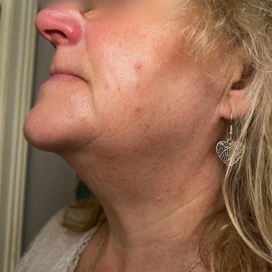 After: polynucleotides to the neck, side view