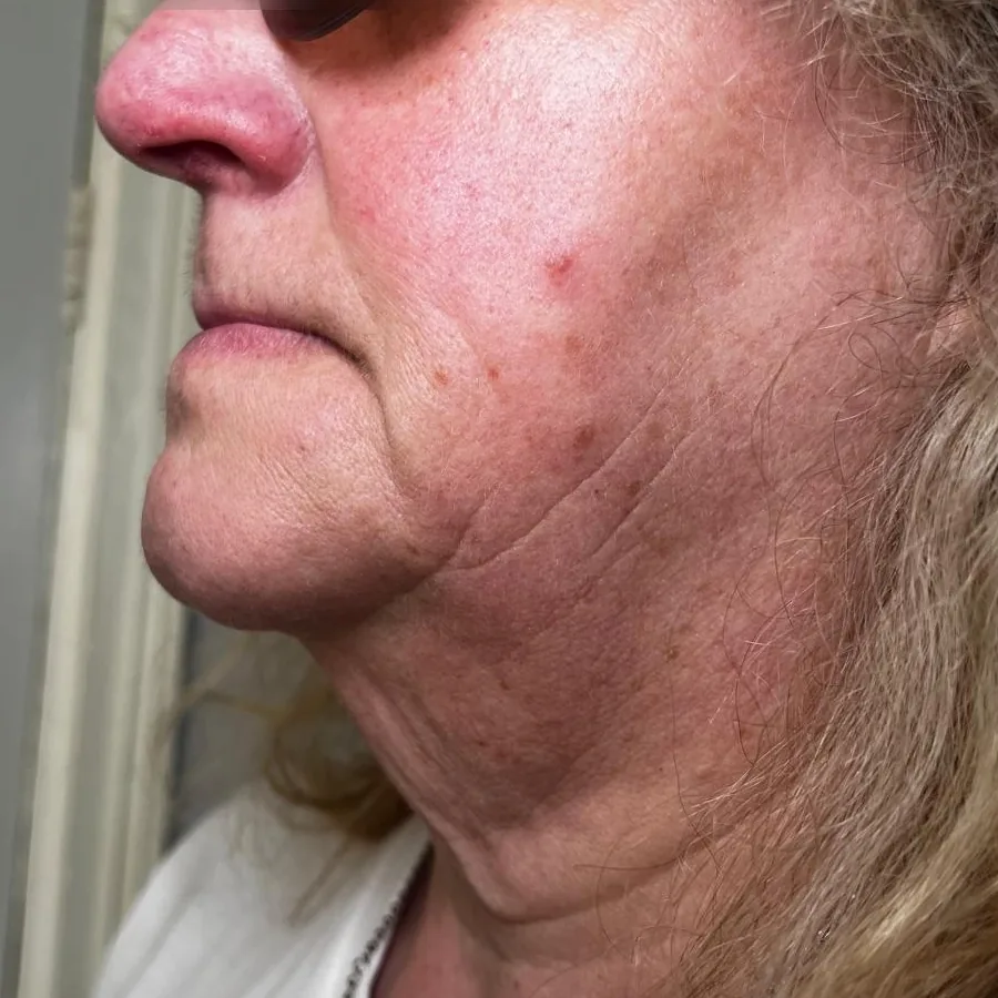 Before: polynucleotides to the neck, side view