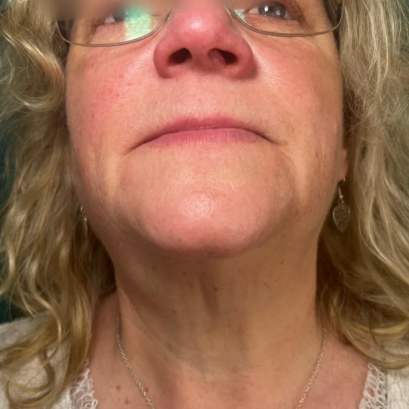 After: polynucleotides to the neck, front view