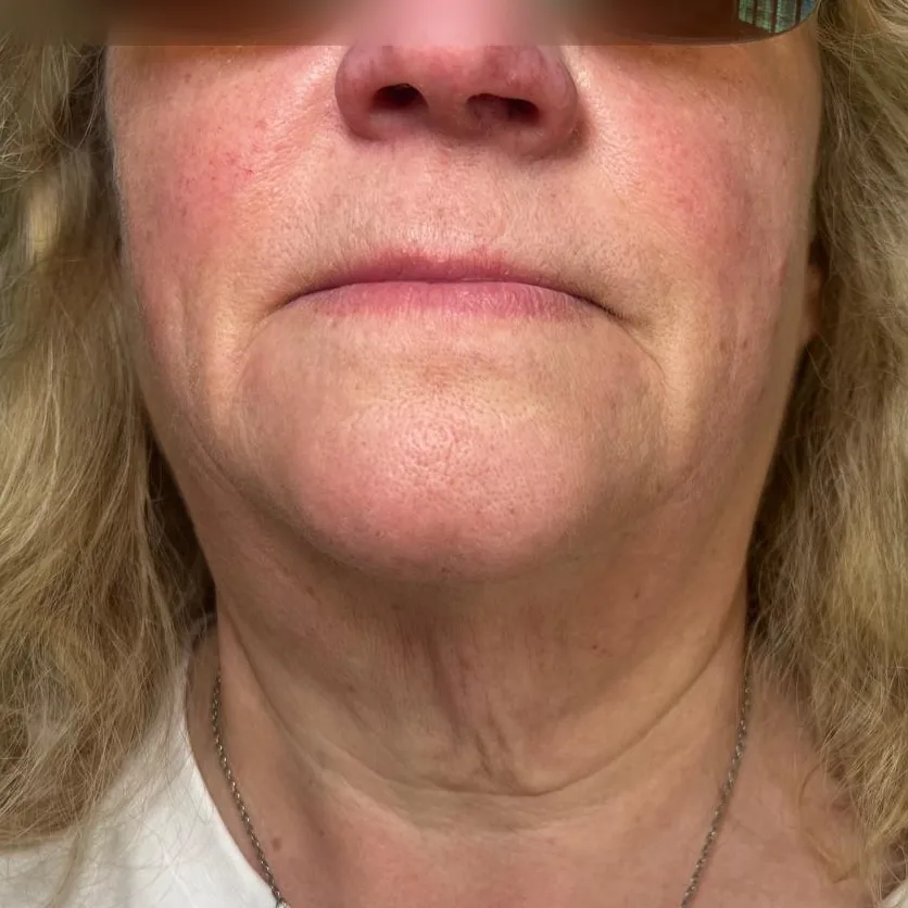 Before: polynucleotides to the neck, front view