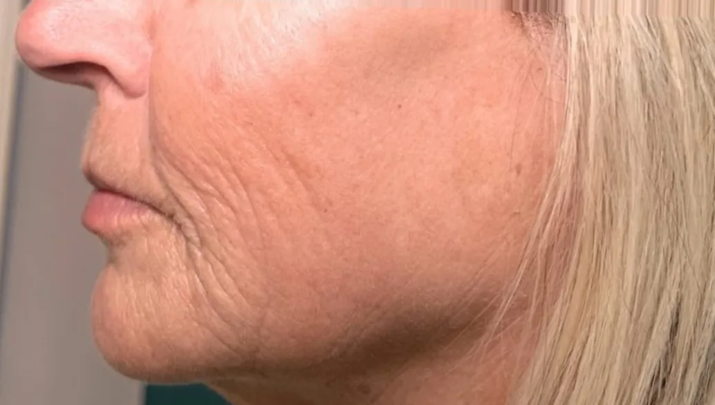 After: Stylage HydroMax skin booster to the lower face