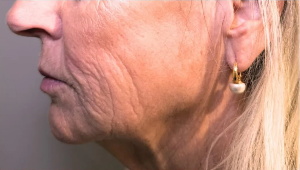 Before: Stylage HydroMax skin booster to the lower face