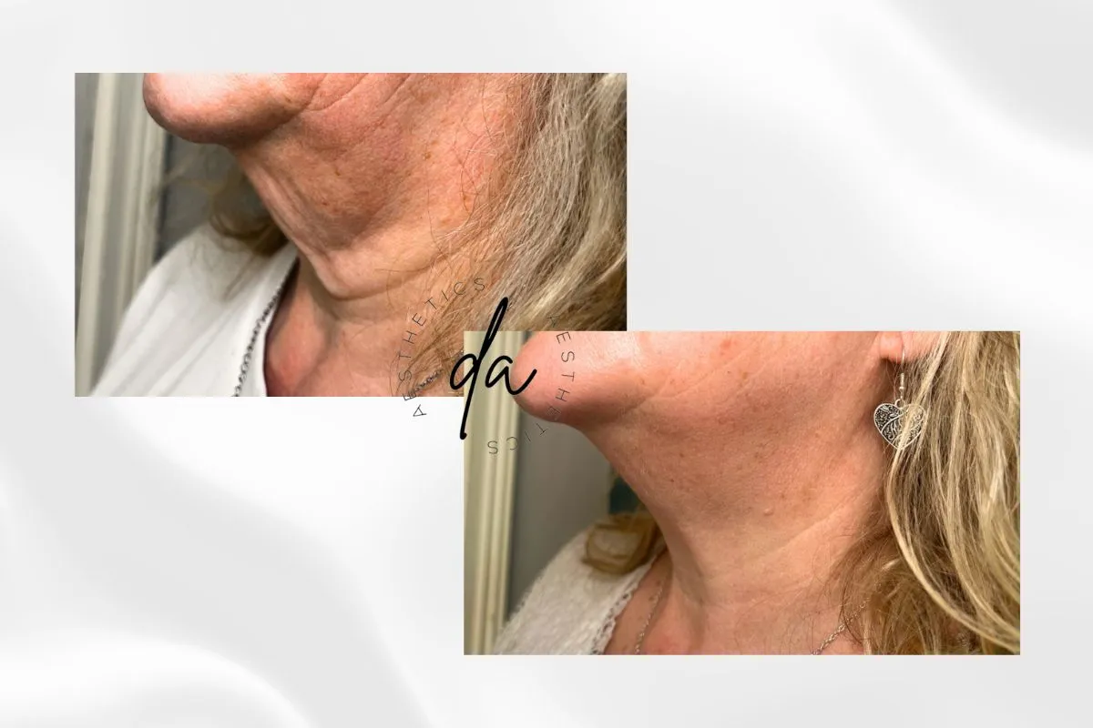 Before and After Polynucleotides Treatment On the Neck After 1 Session